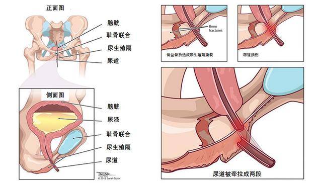 骨盆骨折·后尿道狭窄·勃起功能障碍