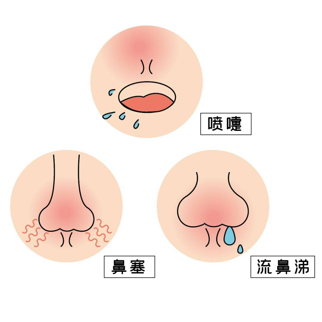 过敏性鼻炎主要有以下四种症状