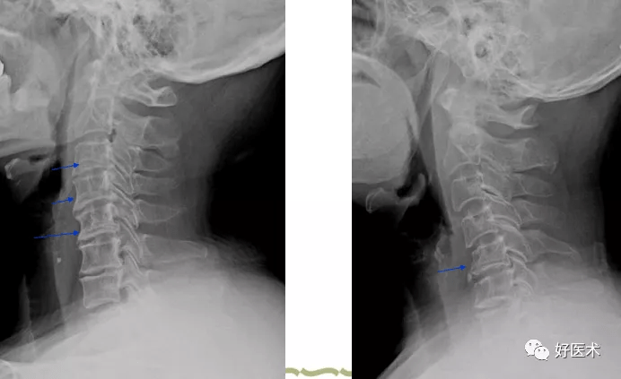 颈椎病解剖,经典影像改变,看这一篇就够了!