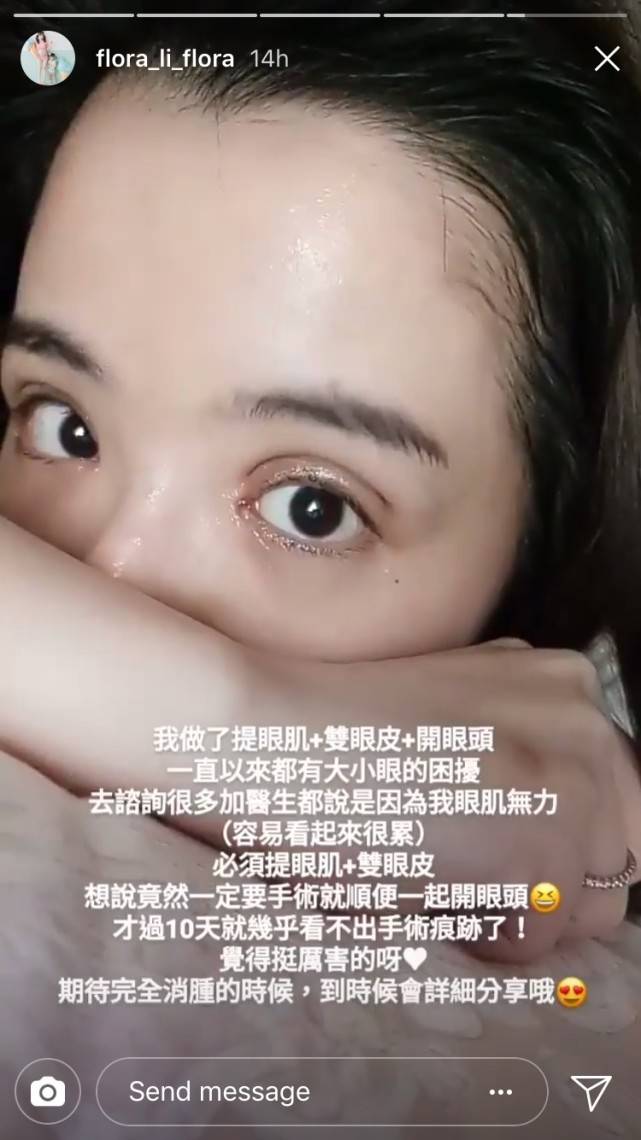 花花|甜美模特身高仅148cm，做3项整容手术后，自曝又在鼻子动刀