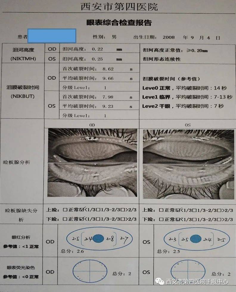 【医学揭秘】怎样判断干眼严重程度?神器来啦!