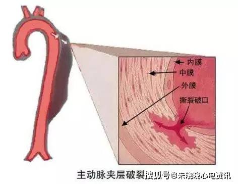 什么是主动脉夹层?