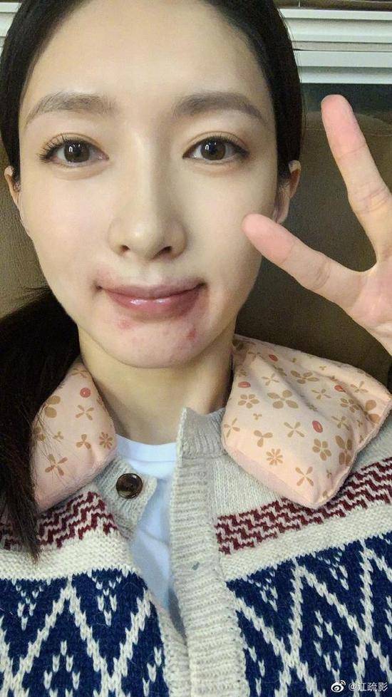 江疏影晒照下巴痘痘醒目搞怪邀请网友一起吃桃
