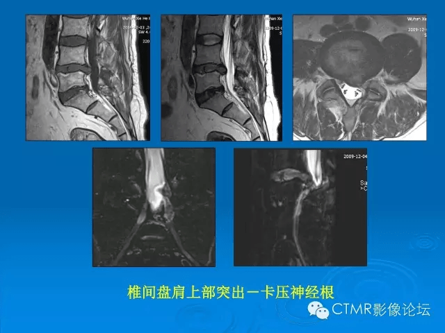 椎间盘退变某些mr征象的再认识