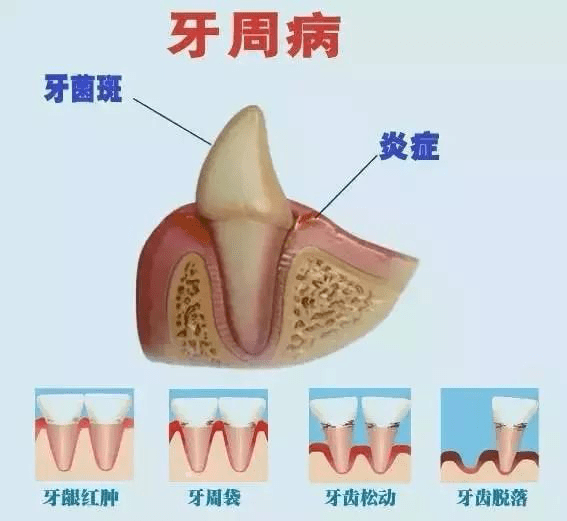 大连齿医生口腔 被小瞧的牙周病后患无穷,心脏病都与它有关