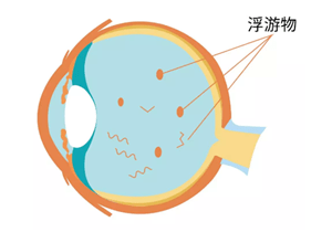 玻璃体腔丝状物在视路中易误以为眼前的"蚊子"