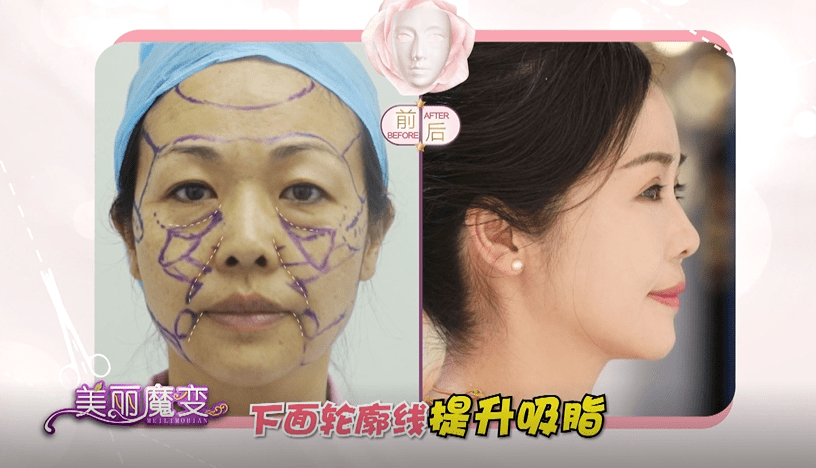 樊女士|四惠医美姚乃君主任速提美案例故事：女人打不垮，更要脸不垮