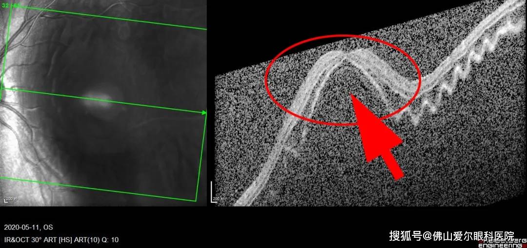 扫描图右眼oct扫描图专家提示:并不是每个高度近视都会发生视网膜脱落