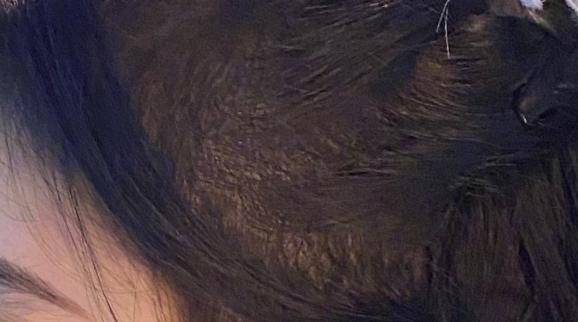 慎入|鞠婧祎再次暴露真实发量，痕迹明显密集恐惧症患者慎入