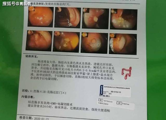 做了胃肠镜吓一跳:一家4口都有息肉,父亲长了13颗,将要癌变