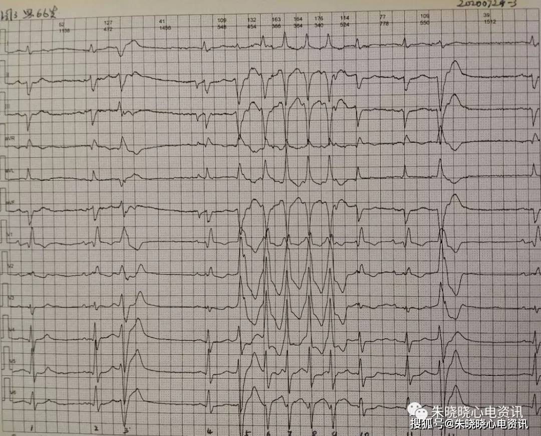 卢老师看心电图-- 交界性逸搏 多源室性早搏二联律 2020-7-29