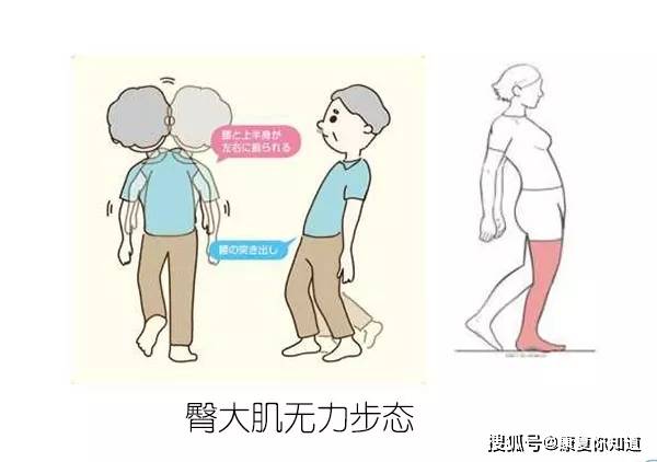 04 臀大肌无力步态——原因:伸髋肌群无力. 表现:行走时躯干