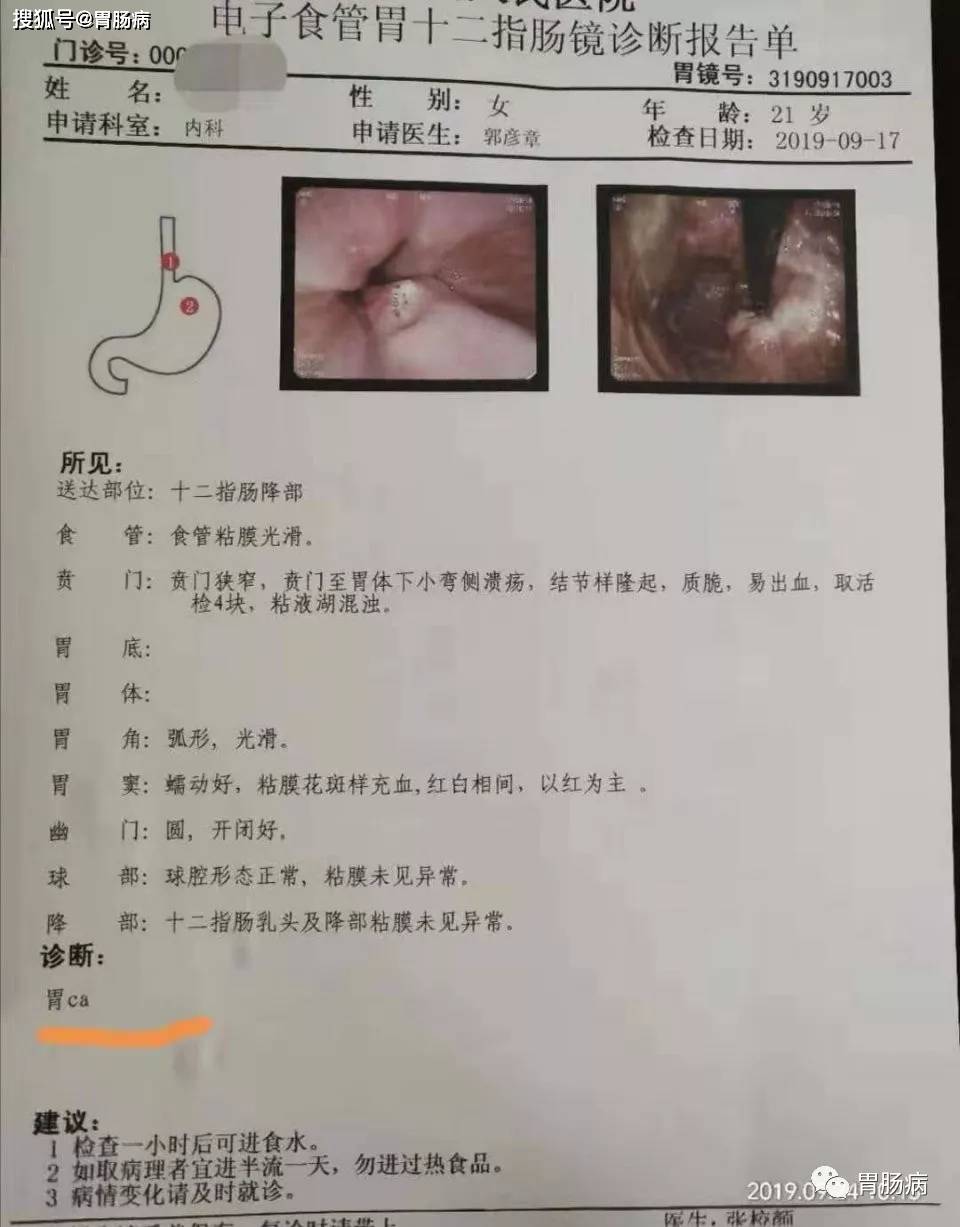 原创我从医以来发现的年龄最小的胃癌——21岁的女大学生!