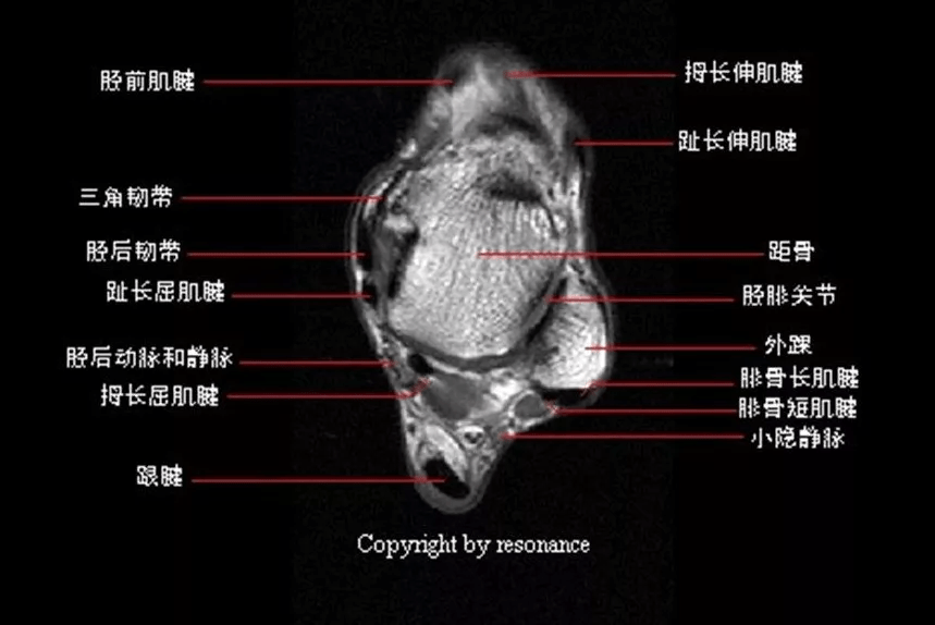 踝关节mri解剖及7种常见损伤类型影像表现