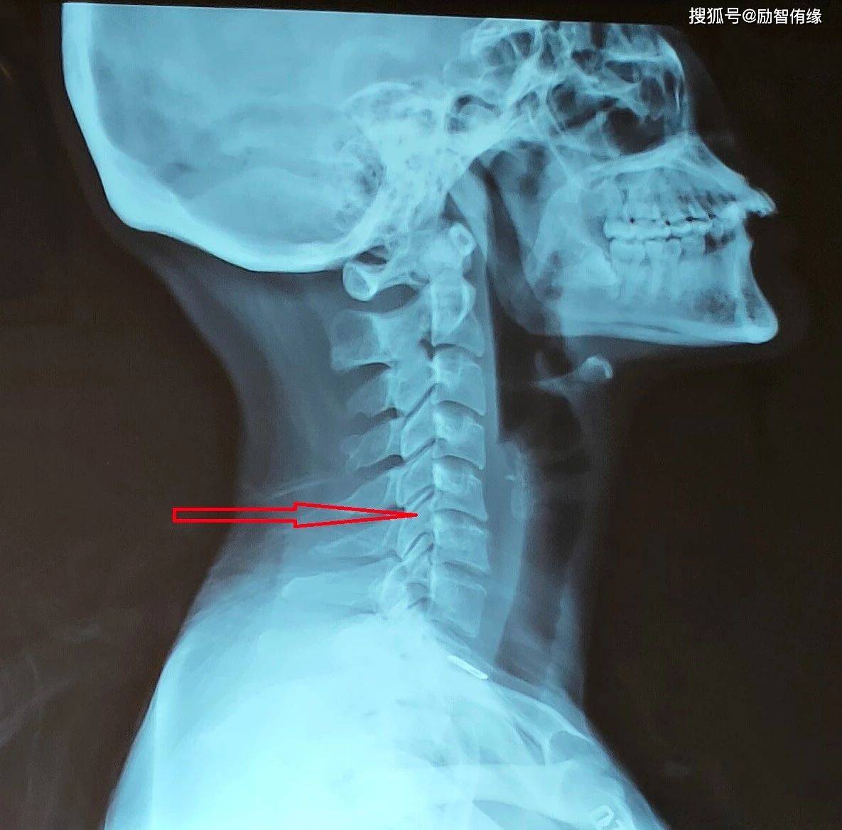 侧位x片上看到c5-6椎体后缘增生,椎间隙狭窄,提示其有椎间盘退变.