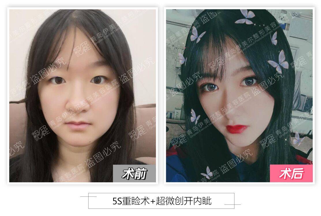 刘长发|青岛伊美尔刘长发：双眼皮是面部的点睛之笔