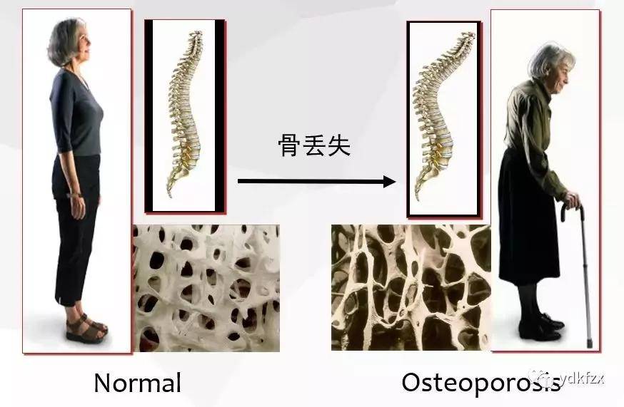 五个表现提示骨质疏松了,如何正确锻炼才能预防骨质疏松症?