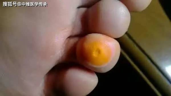 治鸡眼冻疮秘方方2首