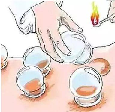 中医拔罐知识知多少?为什么拔罐后会出现血点,瘀血,水泡等现象