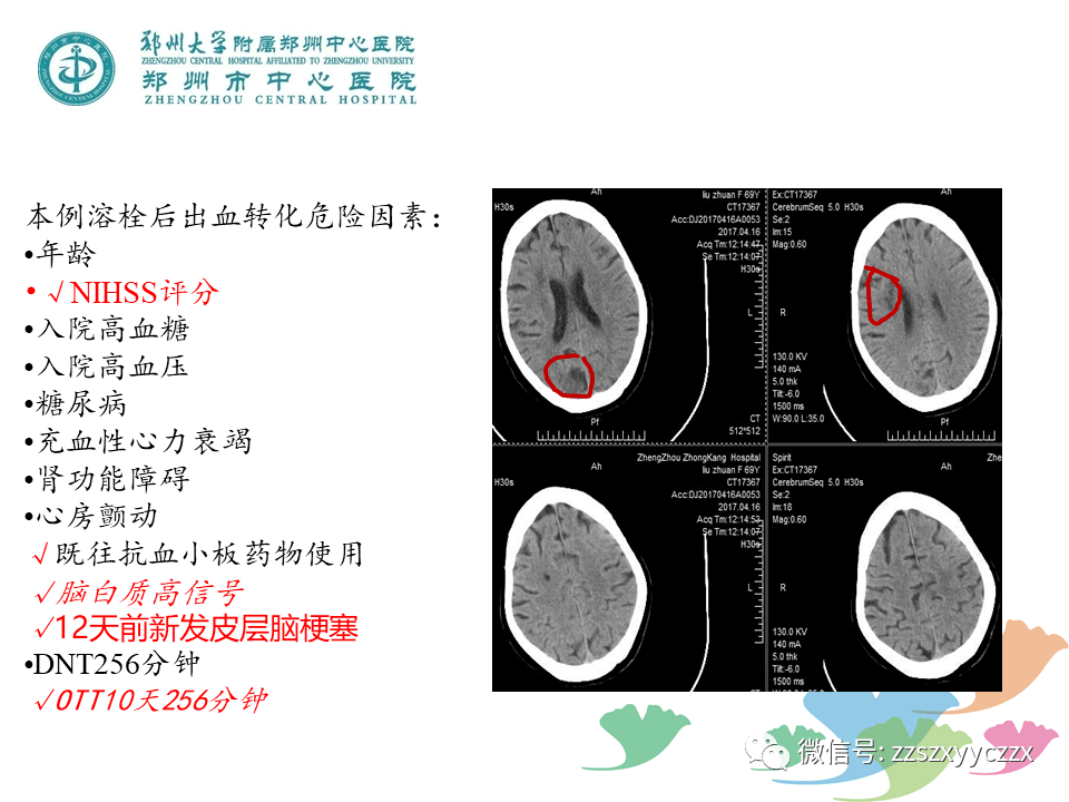 脑血管病 | 静脉溶栓并发症(脑出血转化)的管理