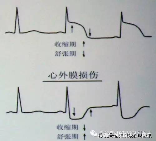 临床必备:2小时学看心肌缺血心电图