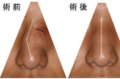 你一定要知道90的人都有鼻中隔偏曲必须要手术吗