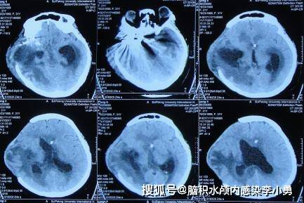 脑血管畸形术后4次脑室外引流致昏迷 颅内感染3种细菌,间断高热2月余