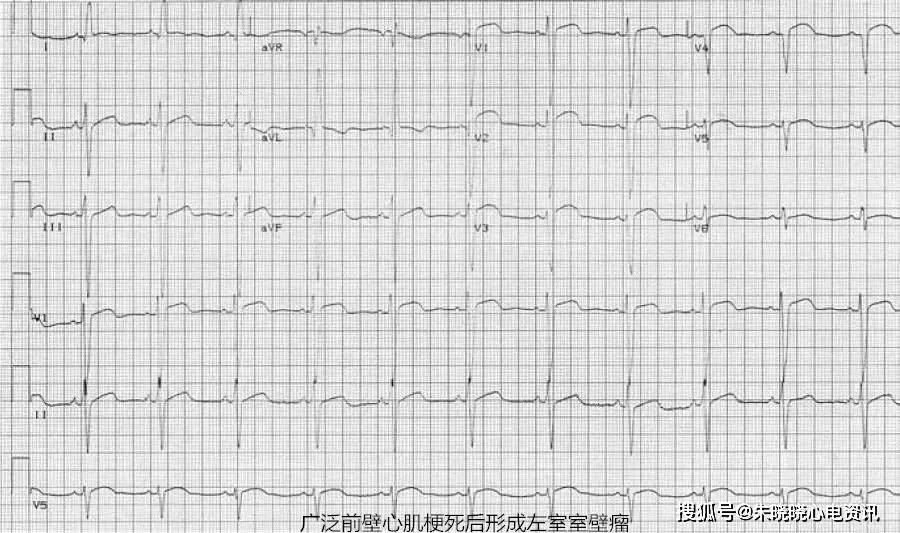 13种引起st段抬高的疾病_心电图