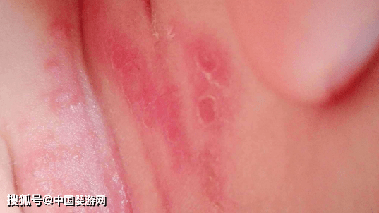 宝宝|湿疹宝宝如何护理?聪明的家长都在这样做!