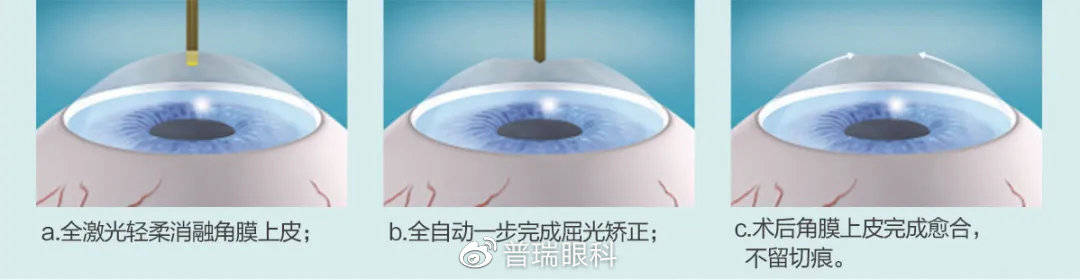 基于(t-)prk和lasik,角膜屈光激光手术两位"课代表"——全飞秒smile