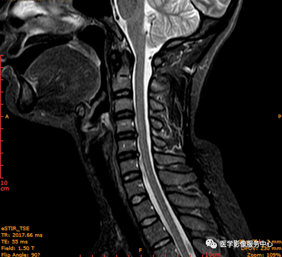 此病例为c4-5椎间盘后缘hiz,工作中颈椎椎间盘hiz发生率不高