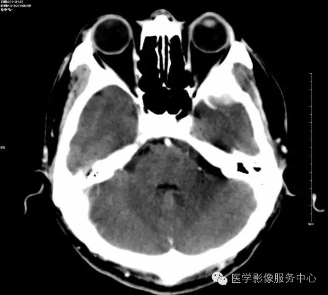 头颅ct的观察盲区,你都知道吗?