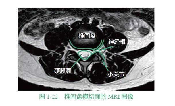 如何判断椎间盘突出是否严重从这几种表现来看