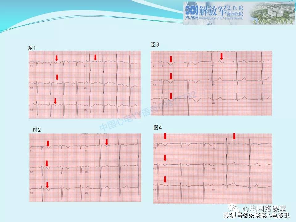 肺栓塞心电图表现及鉴别诊断