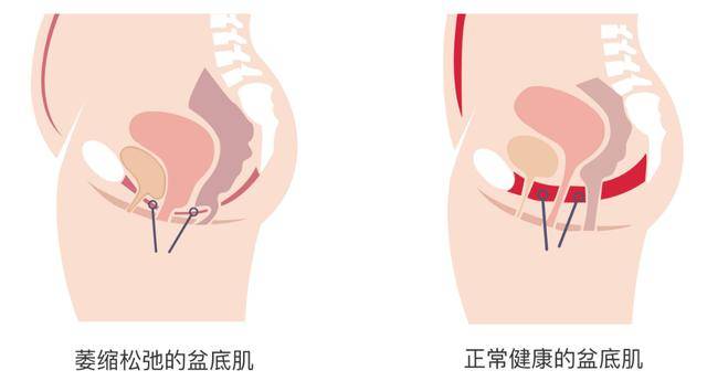 盆底肌是什么肌？产后盆底肌应该如何修复？