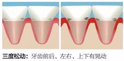 得了牙周炎 并且牙齿松动怎么办