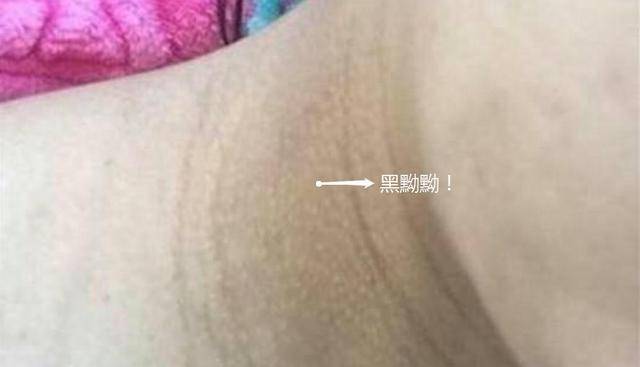 女人怀孕后3个地方会变黑医生别尴尬是宝宝发育好