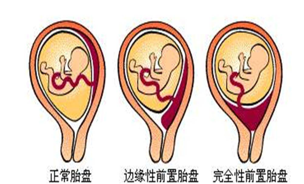 原创女性这三种行为,很容易引起"前置胎盘",堵住胎儿出生的"路"