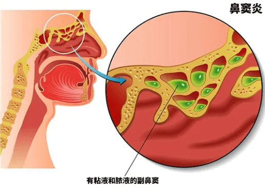 由于肿胀或水肿的鼻粘膜阻塞了在中鼻道和上鼻道的鼻窦开口所致.