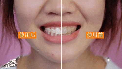 怎么才能让牙结石少点 4e00f0281ccd4681a8c8481ab7cdc23f.gif