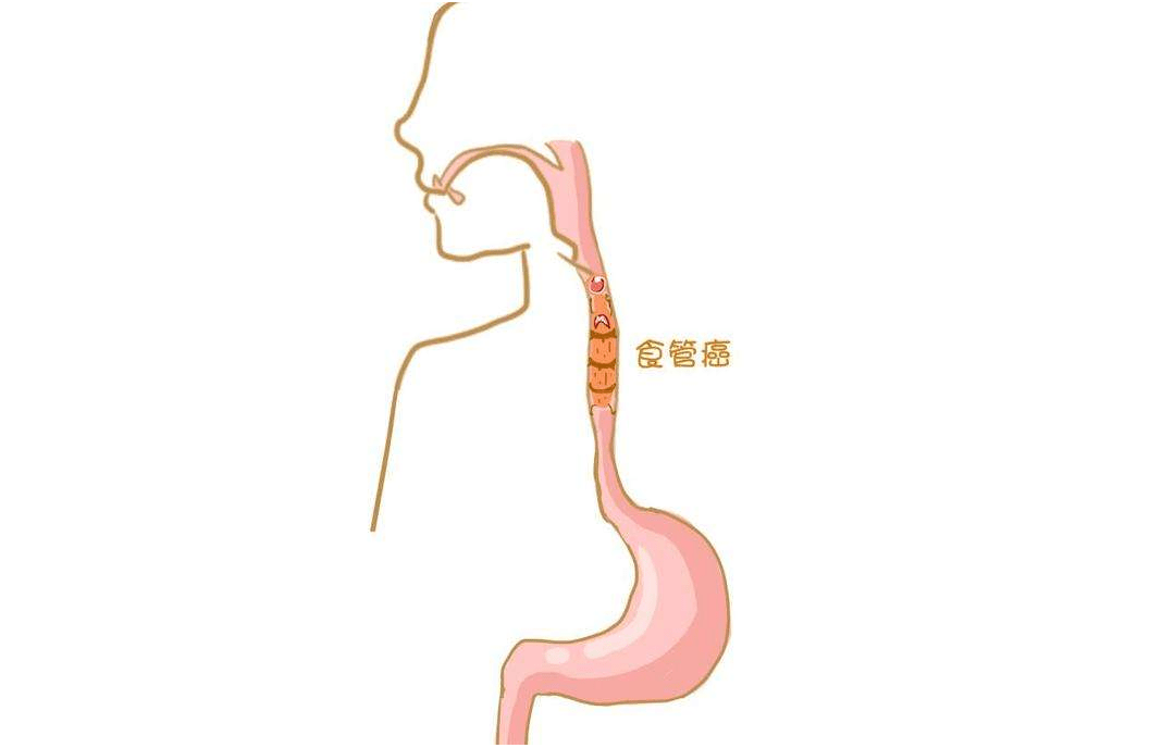 食道癌这些症状预示着癌症出现了转移