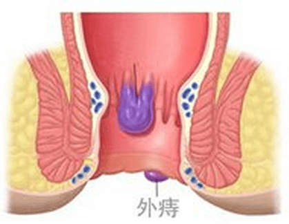 外痔主要症状为肛门不适,潮湿不洁,瘙痒,疼痛和出血,不同类型的外痔