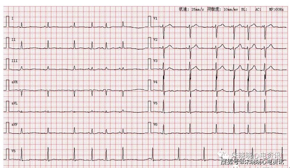 每日读图 || 第1133期 房性心动过速