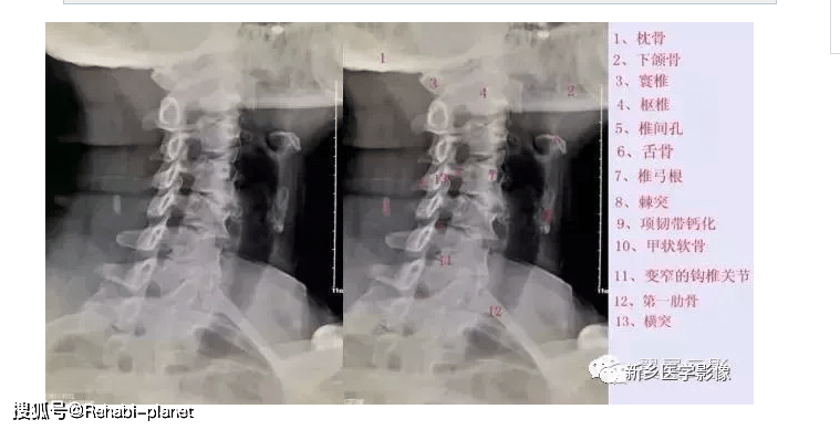 史上最详细的颈椎x线解剖 解读(经典收藏)
