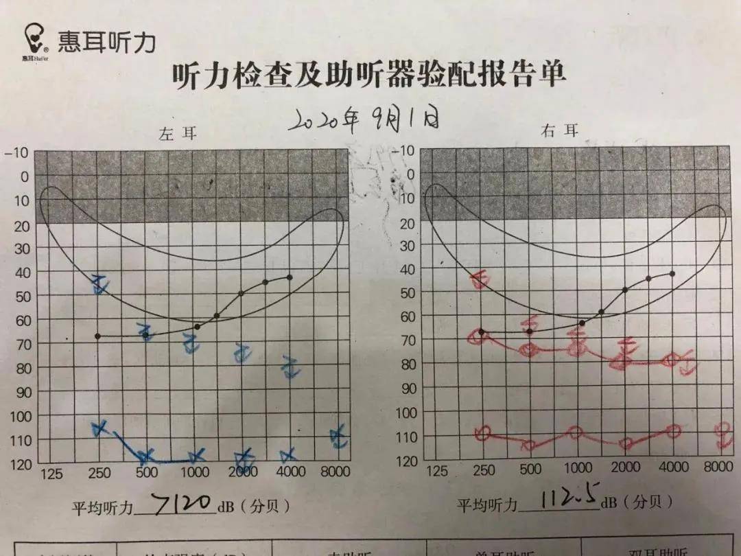 主观检查:纯音测听结果显示右耳极重度听损,左耳听力逐渐下降至极重度