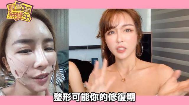 辣模雪碧自曝整容史花费400万做过15次大手术为垫额头打骨钉