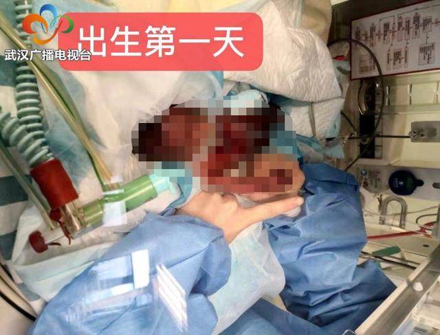 女婴|不容易!6个月超早产女婴活下来了 出生时仅500克