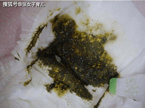 宝宝|其实是父母们误解了，别再瞎担心了新生儿的这些“异常”现象