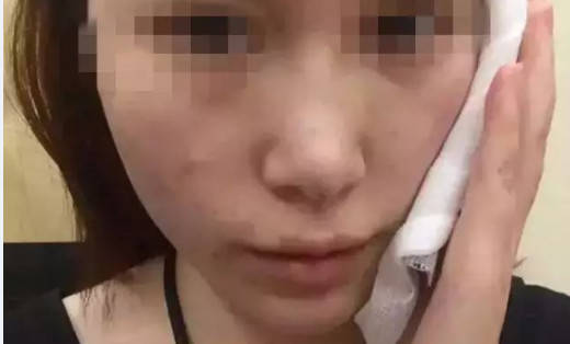 自己怎样修复凹陷 05a447acd4274c74ab75ec8f56624ef1.jpeg