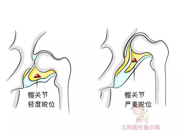 宝宝|宝宝腿纹臀纹不对称就是髋关节发育不良吗？为啥说越早发现越好